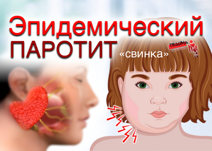 Профилактика эпид.паротита. Профилактика эпид.паротита.
